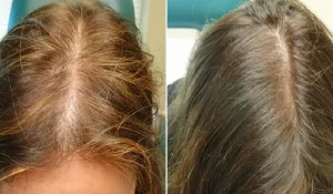 تفاوت مزوتراپی و پی آر پی